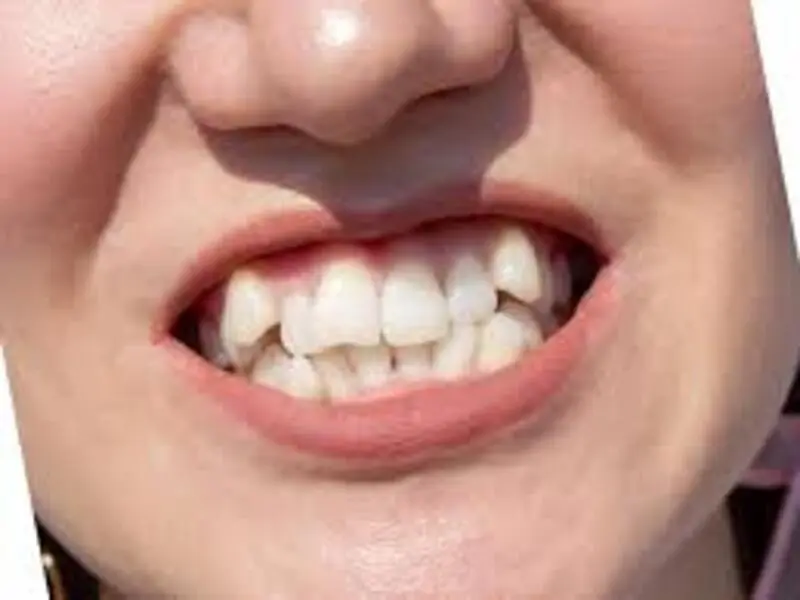 4. Loose or Shifting Teeth