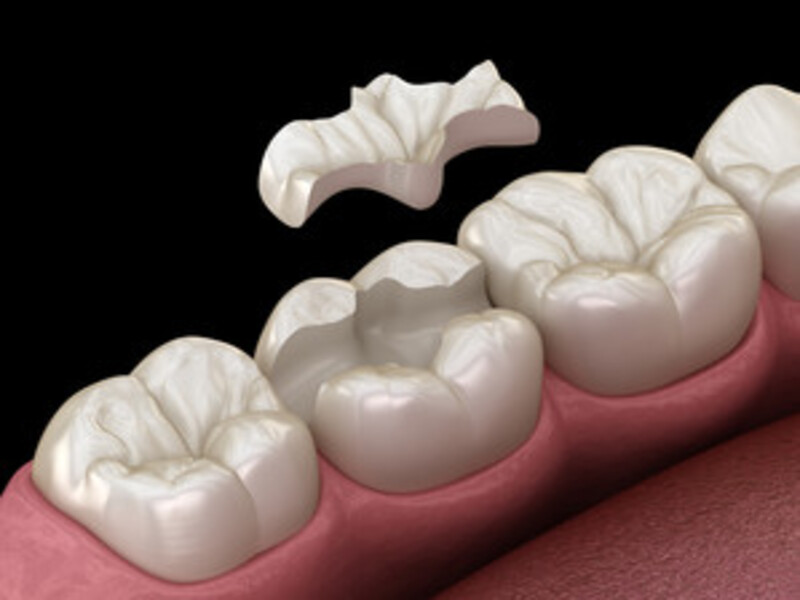 6. Severely Cracked or Damaged Teeth